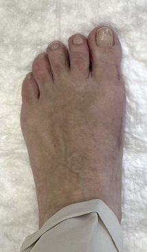 Нallux valgus, операция Scarf (открытая)